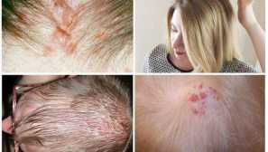 Kaj lahko uši z uši z osebo in kako se posredujejo